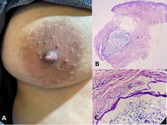 Large pedunculated polyp left breast nipple.